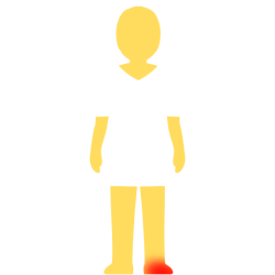 A person with no hair or face, an emoji yellow skintown, and a white pair of shorts and pants with no visible divider between the two. there's a glowing red spot on their right foot.